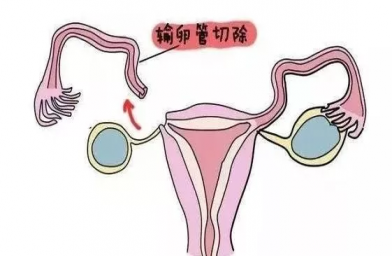 上海慈铭博鳌国际医院三代试管婴儿，切除双侧输卵管还能做试管婴儿吗？
