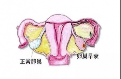 上海备孕试管婴儿知识_为什么年轻女性也会卵巢早衰？如何防止早衰？
